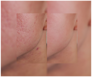 Tabletten voor acne, puistjes en onvolkomenheden met zink, vitamine C, E en B2 van Derminax