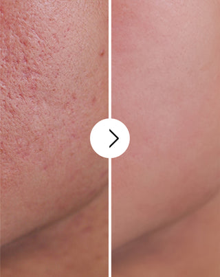 Tabletten voor acne, puistjes en onvolkomenheden met zink, vitamine C, E en B2 van Derminax