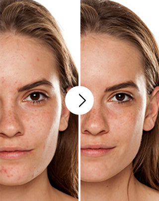 Tabletten voor acne, puistjes en onvolkomenheden met zink, vitamine C, E en B2 van Derminax