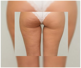 Tabletten voor cellulitis en het verbeteren van de huidconditie met natuurlijke extracten, Cellinea 60 capsules - 5