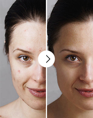 Tabletten voor acne, puistjes en onvolkomenheden met zink, vitamine C, E en B2 van Derminax - 6