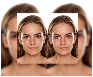 Tabletten voor acne, puistjes en onvolkomenheden met zink, vitamine C, E en B2 van Derminax - 6