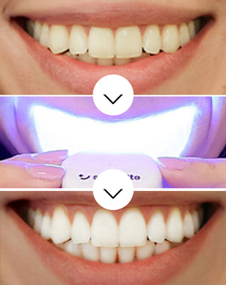 Witmakende tanden set met LED lamp en Light & Bright Smilebite witmakende gel - 3